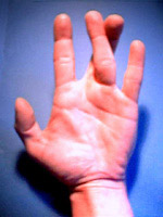 Hand 1